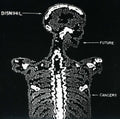 Disnihil - Future Cancers - Vinyl Record